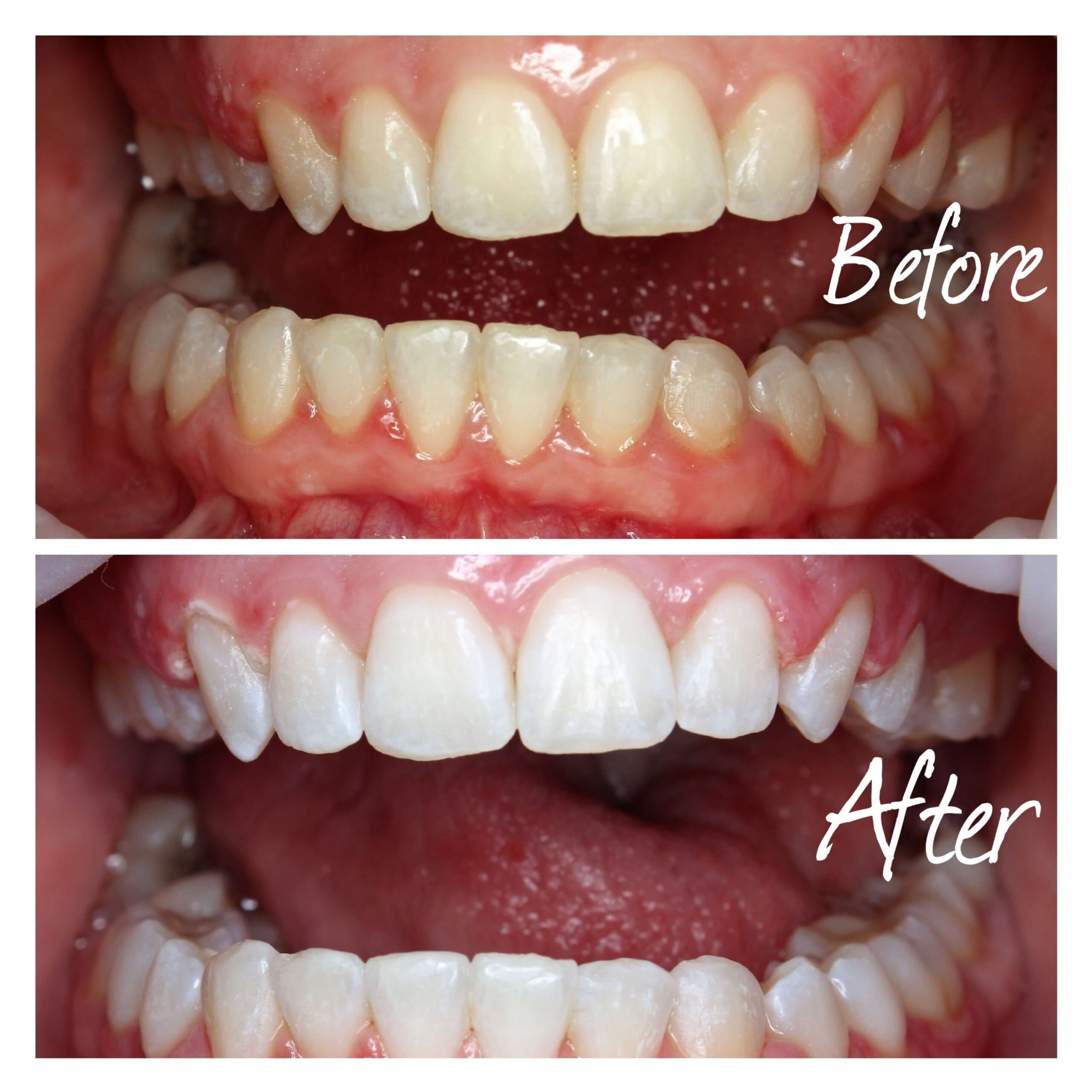 Teeth whitening before and after