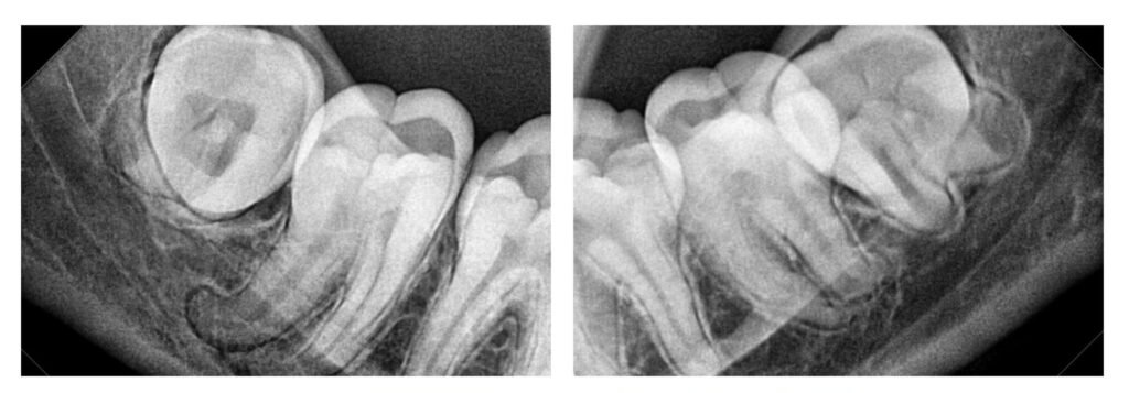 شكل ضرس العقل المدفون في الأشعة وشكله بعد خلعه