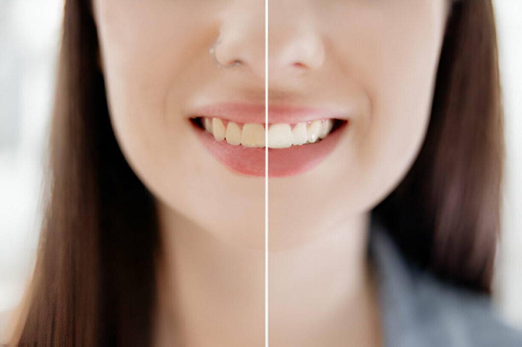 Teeth Whitening in Egypt – The Full Guide