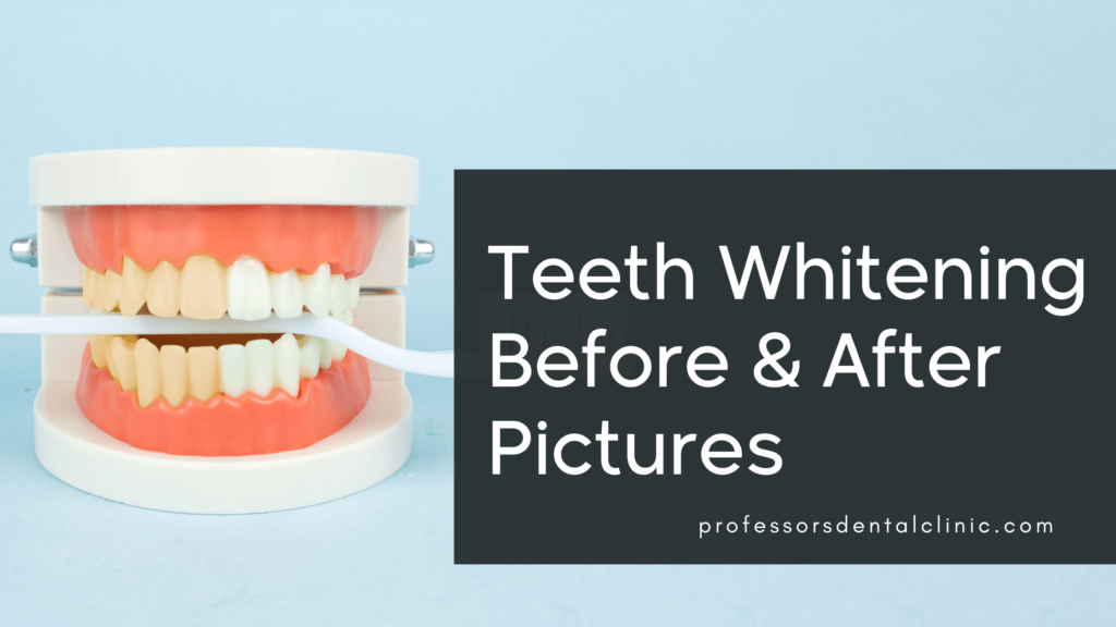 Teeth Whitening Before and After – Best Teeth Bleaching in Egypt