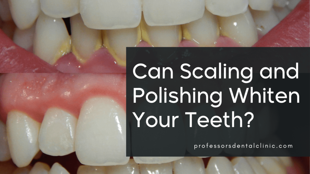 Do Scaling and Polishing Whiten Teeth? Everything You Need to Know