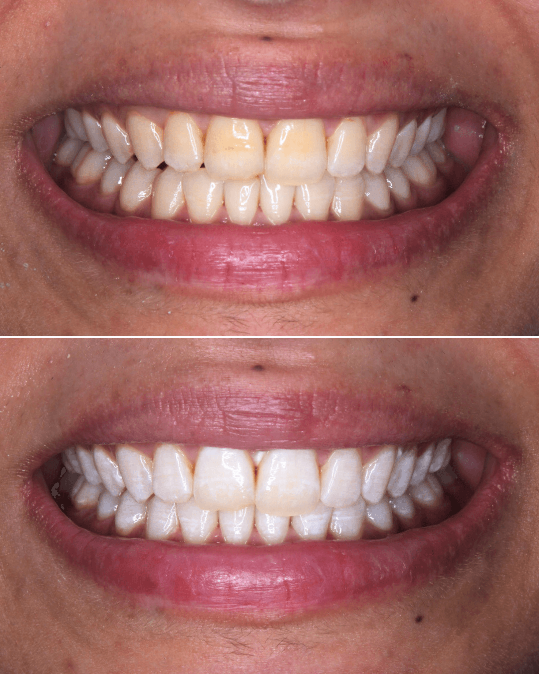 حالة حديثة رقم 2 - صورة قبل وبعد تبييض الأسنان بالليزر