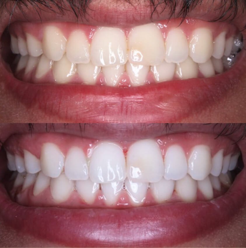 حالة جديدة رقم 3 قبل وبعد التبييض