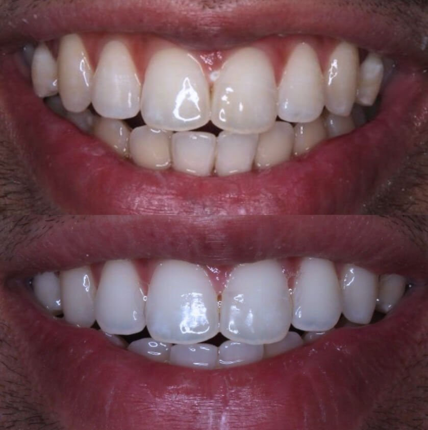 حالة جديدة تبييض بالليزر - قبل وبعد