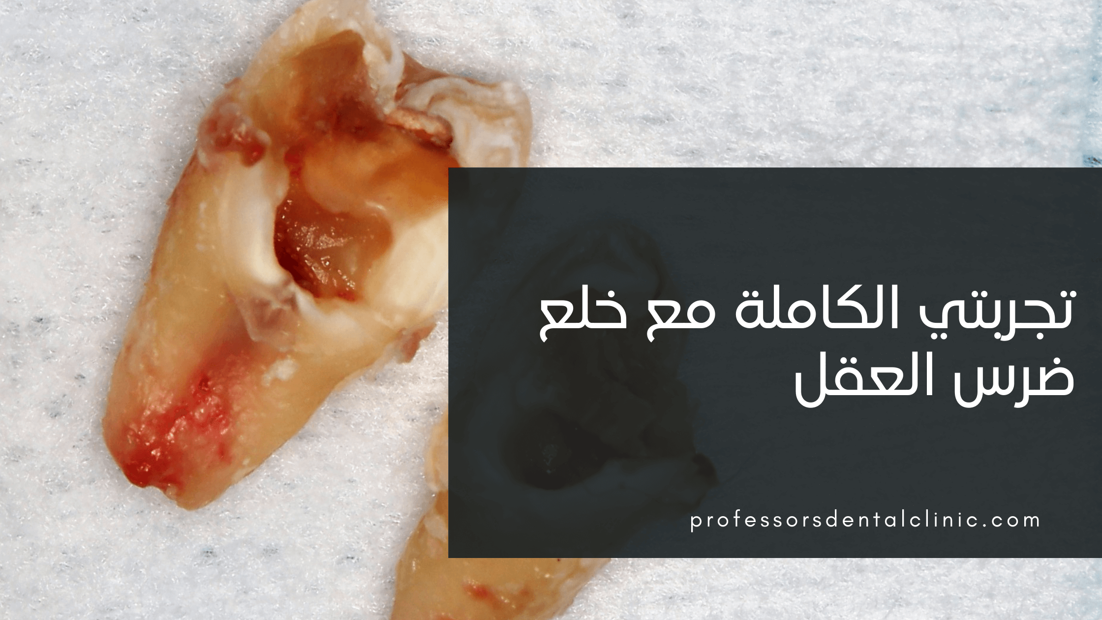 تجربتي مع خلع ضرس العقل - أسهل بكتير مما تخيلت