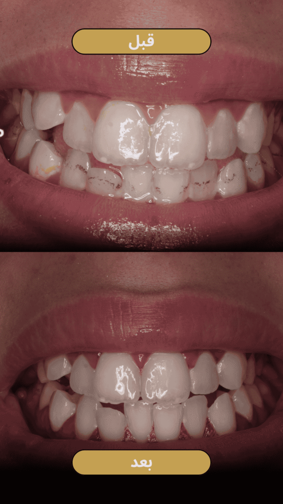 شكل الأسنان بعد تنظيف الجير - الحالة 1