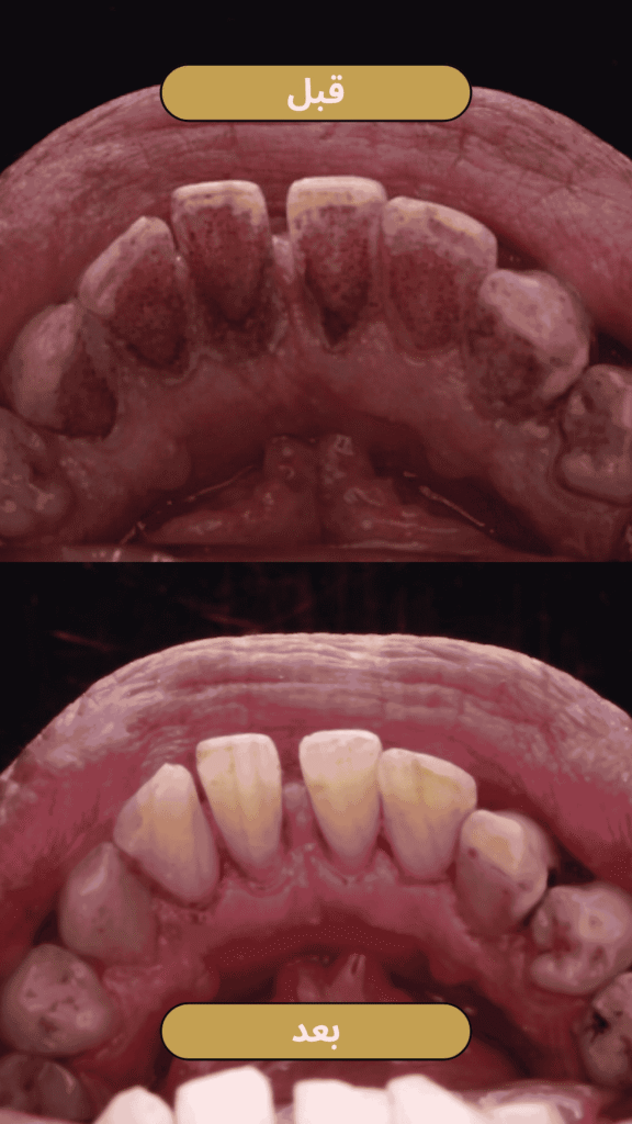 صورة قبل وبعد تنظيف جير الأسنان - حالة جديدة 2026