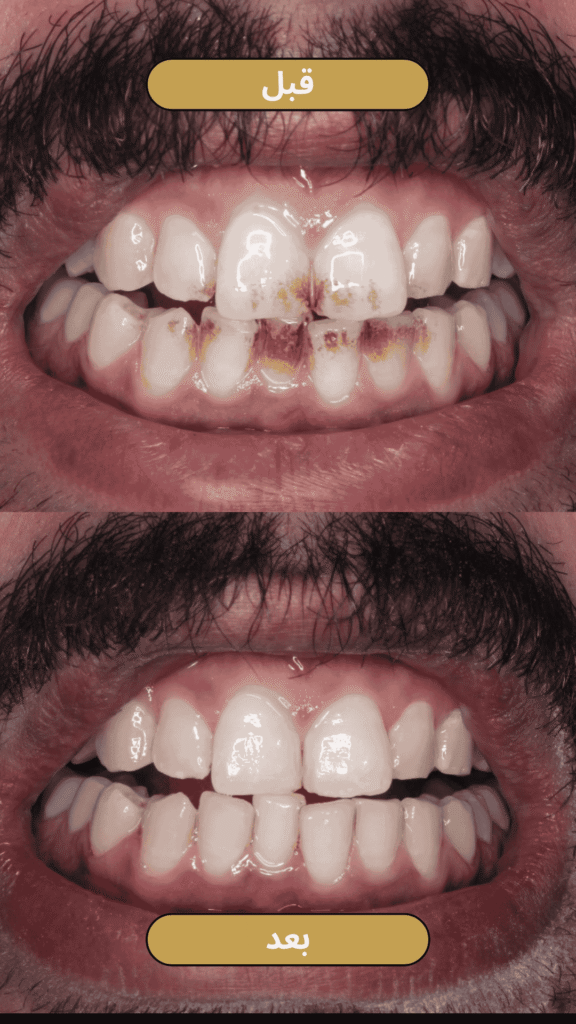قبل وبعد تنظيف الاسنان من الجير - الحالة 2