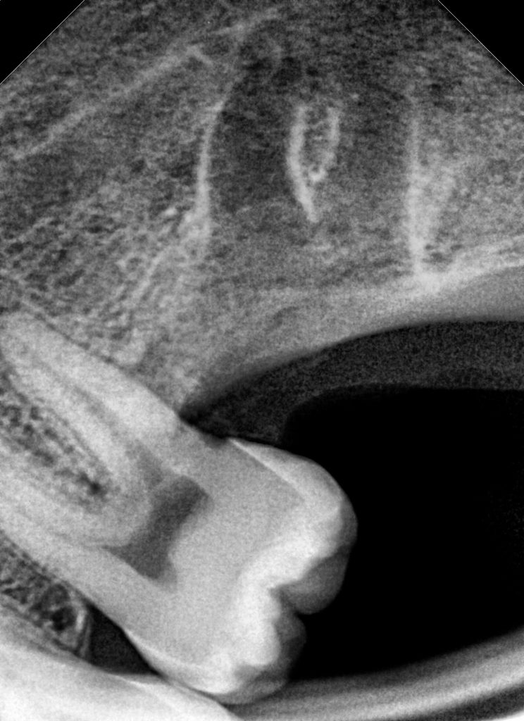 X-Ray After Wisdom Tooth Removal