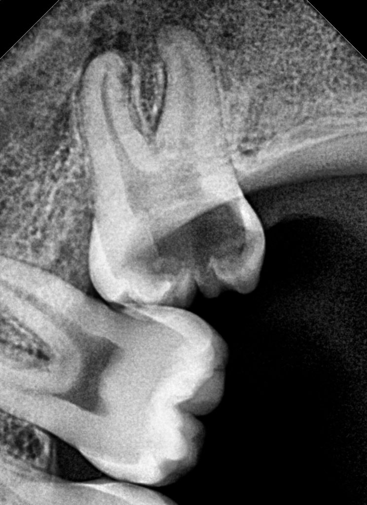 Xray Before Wisdom Tooth Removal