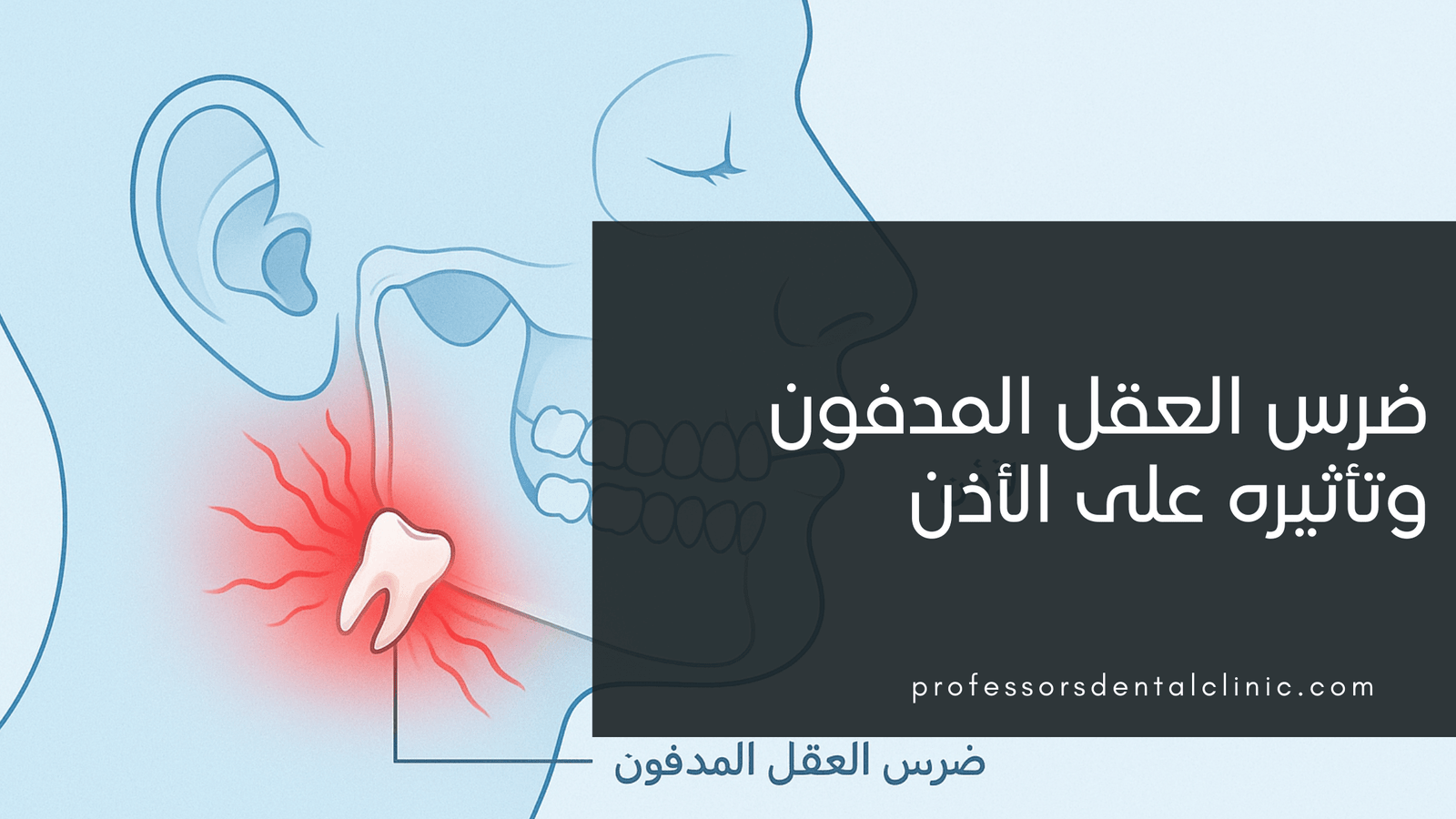 ضرس العقل المدفون وتأثيره على الأذن