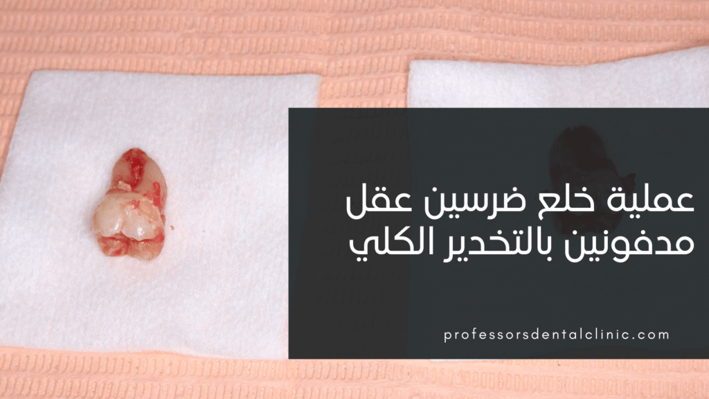 من عيادتنا: عملية خلع ضرسين عقل مدفونين بالتخدير الكلي