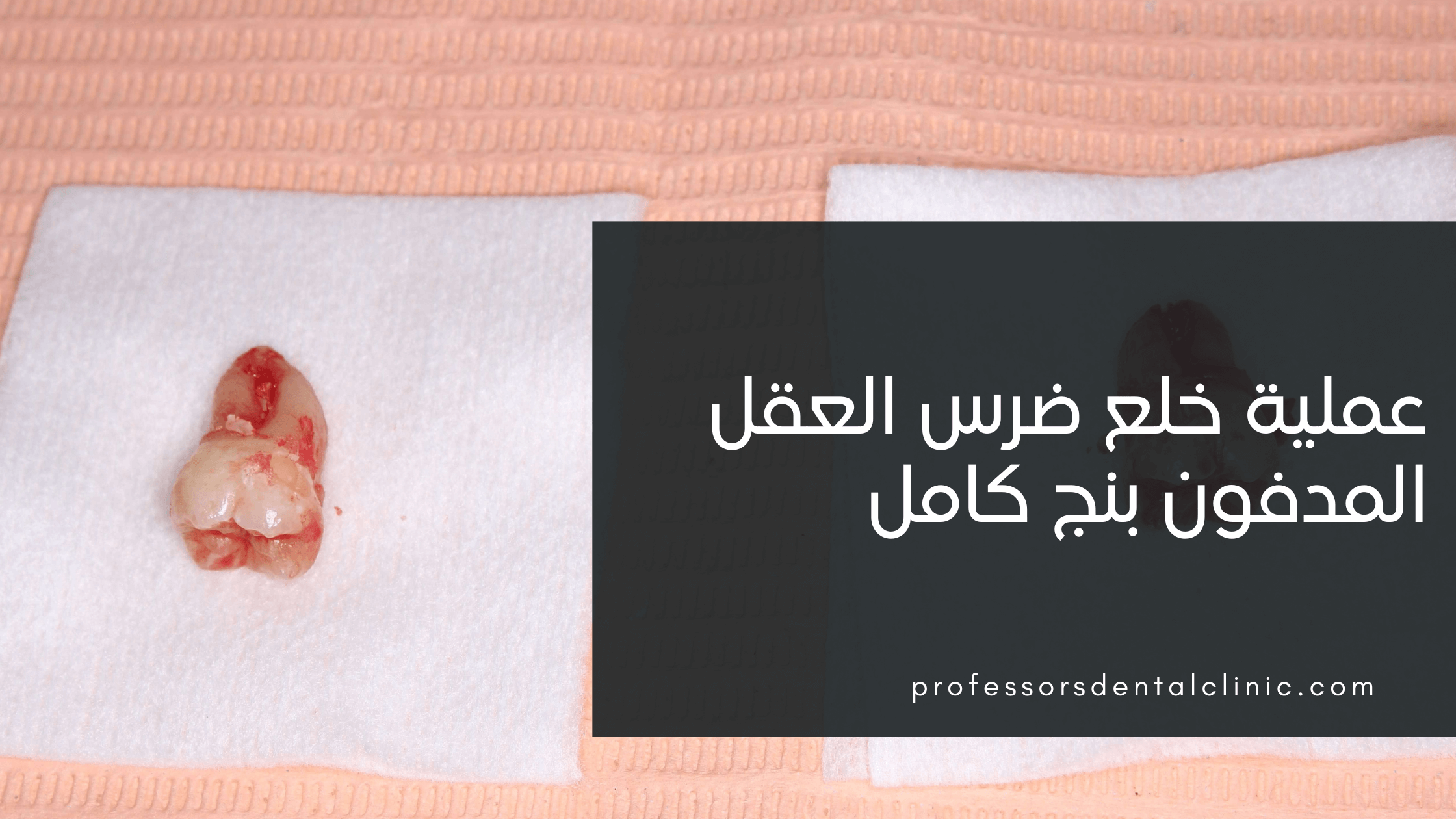 عملية خلع ضرس العقل المدفون بنج كامل – حالة واقعية من عيادتنا