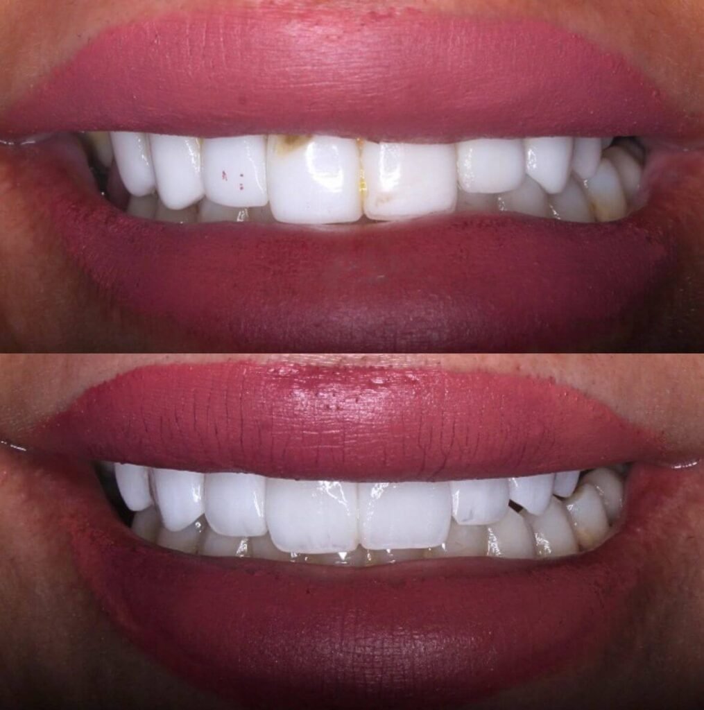 Veneers Case #1 - Before and After -Professors Dental Clinic