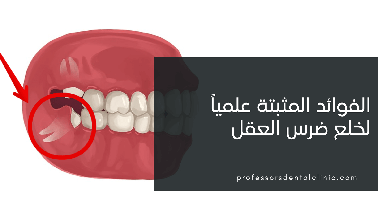 الفوائد المثبتة علمياً لخلع ضرس العقل