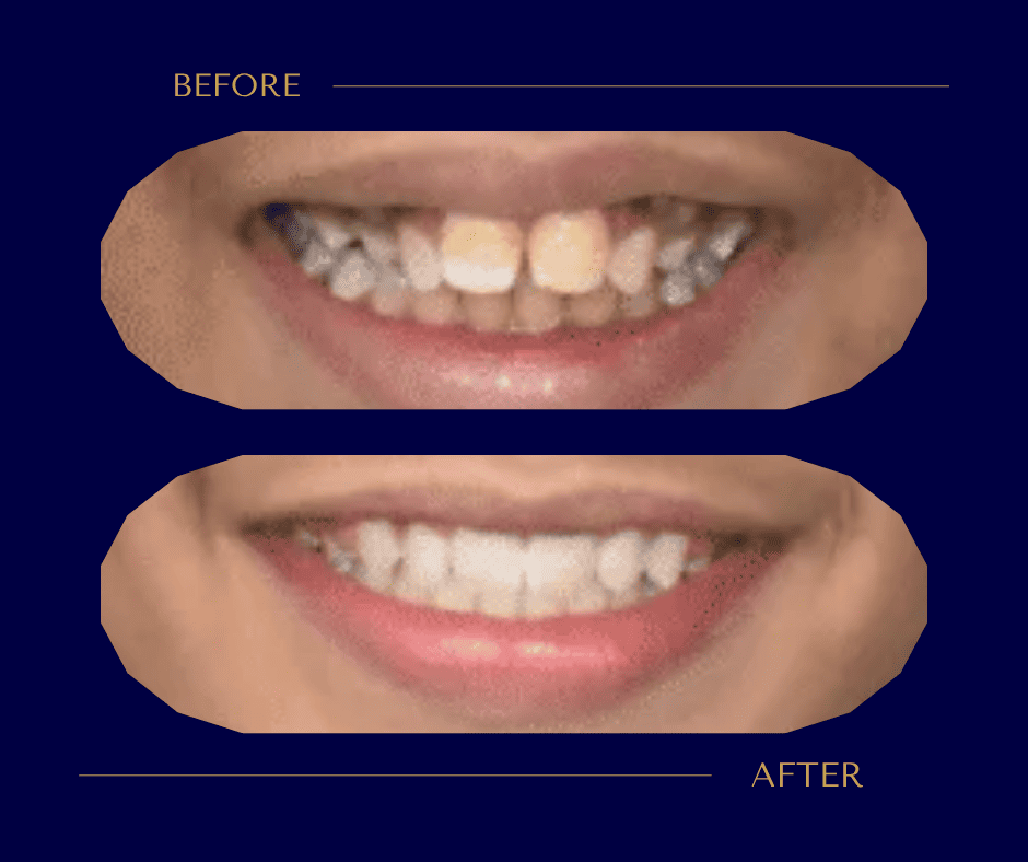 بروز الفك العلوي شكل الوجه قبل وبعد التقويم - تجربة حقيقية بالصور