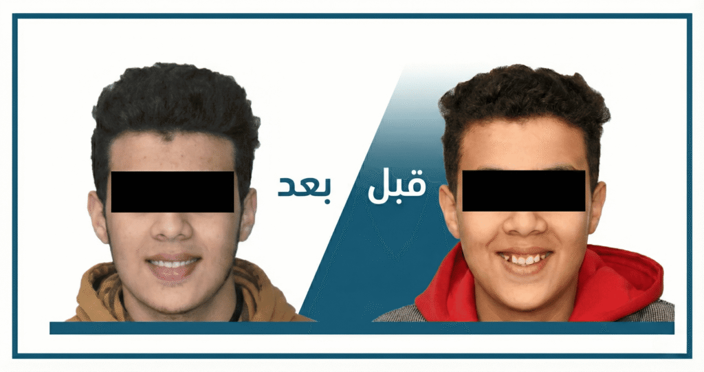 تقويم الأسنان قبل وبعد: نتائج حقيقية من عيادتنا