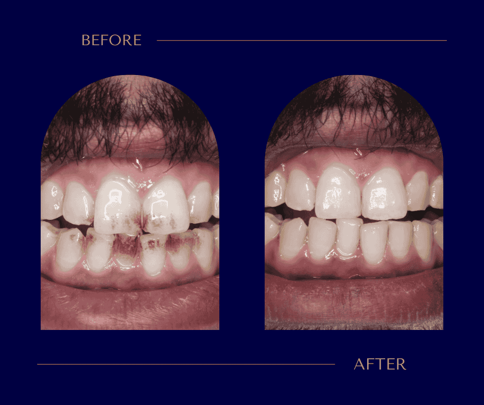 أسنان بيضاء بدون بقع أو تصبغات بعد التنظيف من الجير
