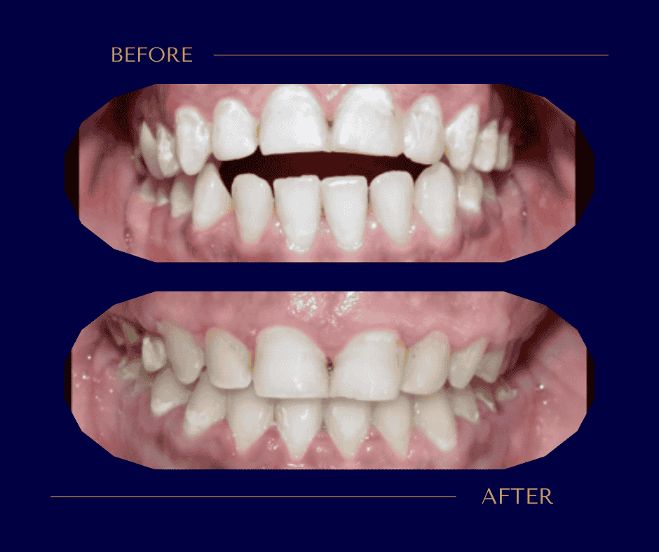 علاج العضة المفتوحة بالتقويم بدون جراحة – حالة حقيقية بالصور قبل وبعد