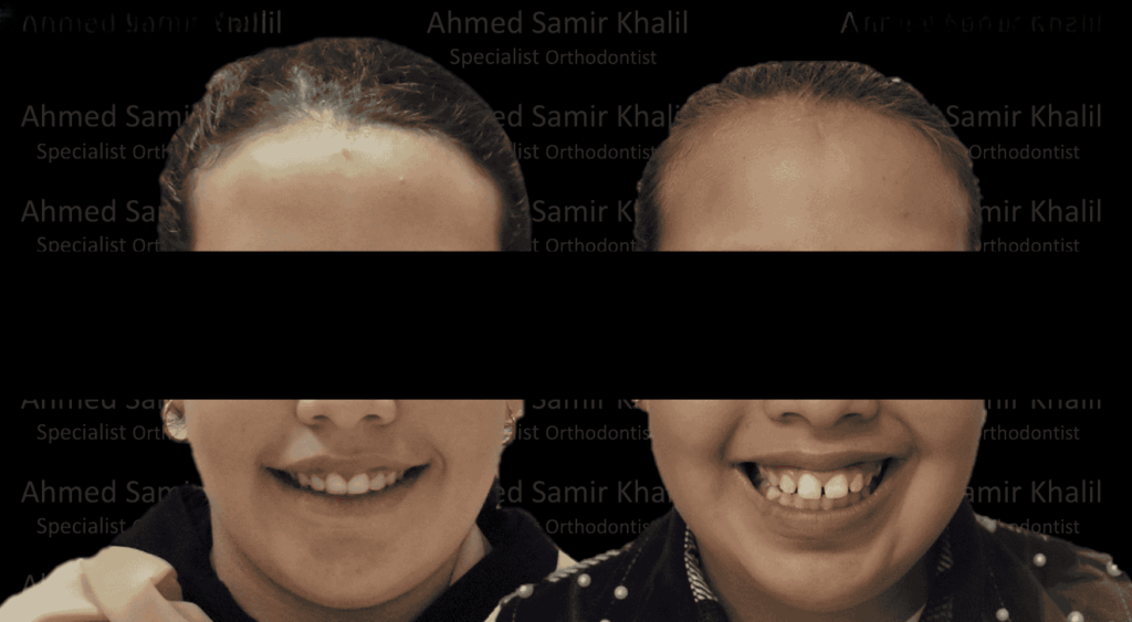 تجربتي مع التقويم الشفاف