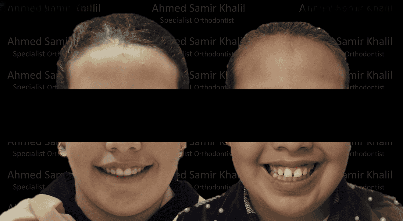 تجربتي مع التقويم الشفاف